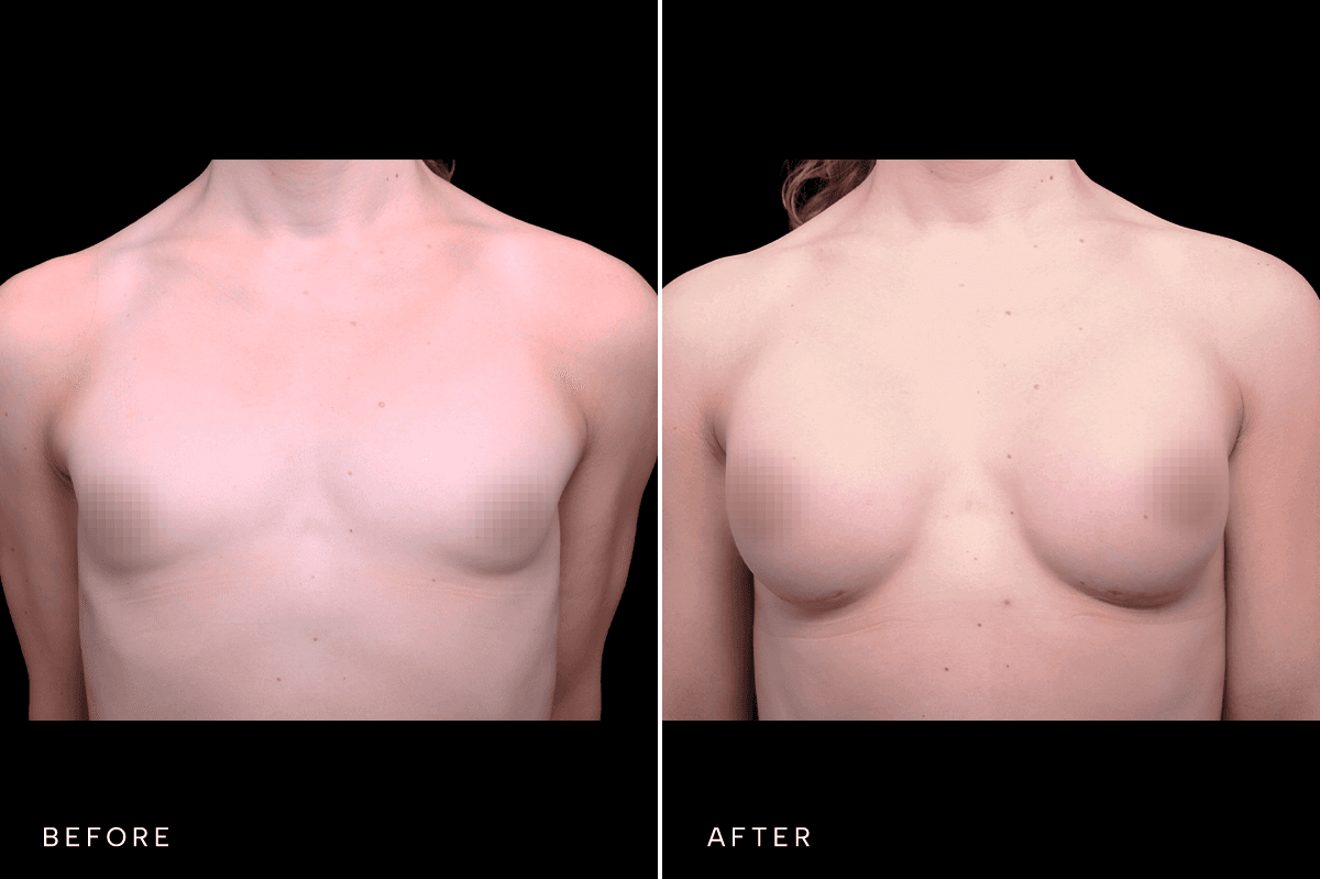 Omni Breast Gallery - BAM GC 4902 - A Front