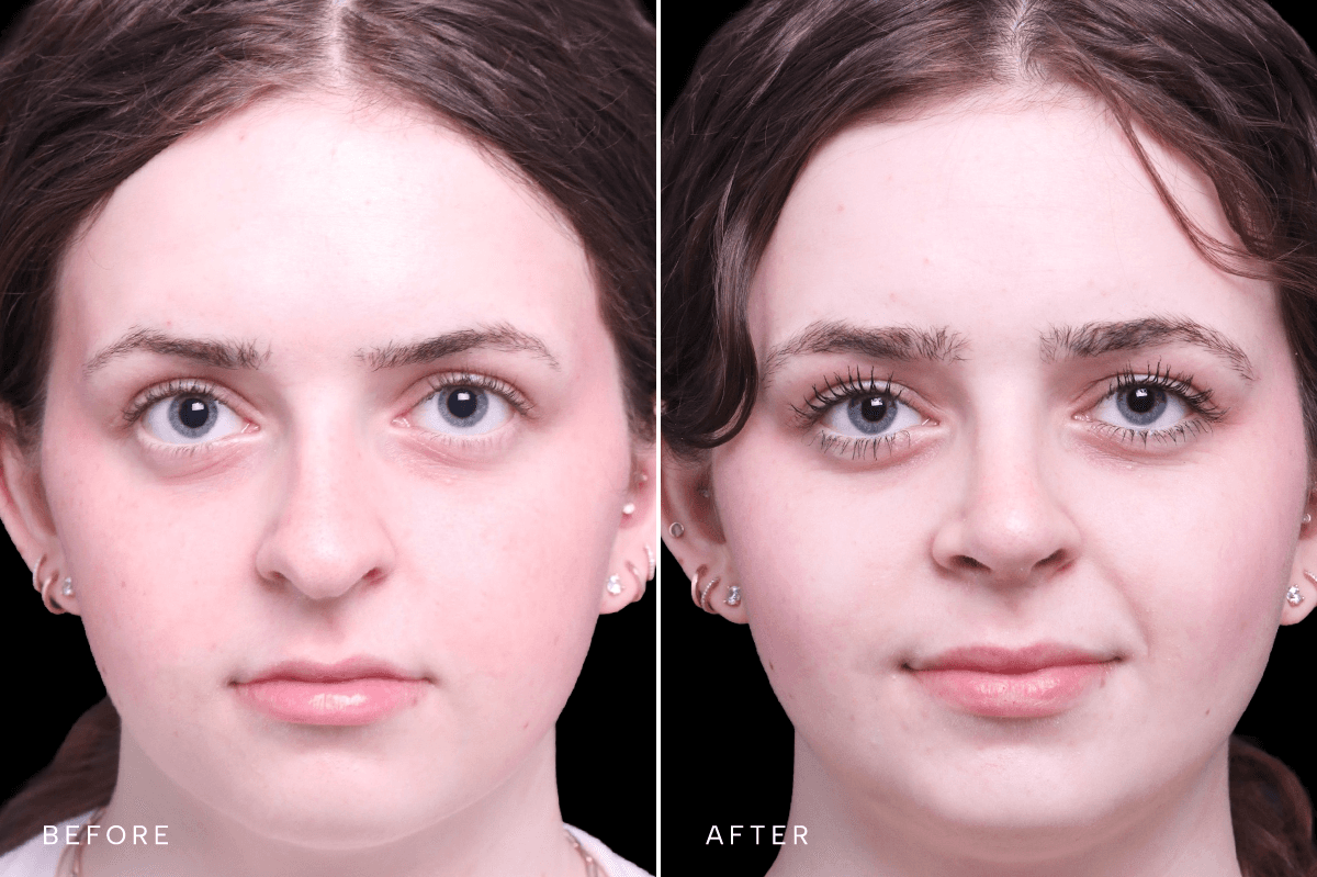 Omni Rhinoplasty Before and After — RHINO 5553 — Front