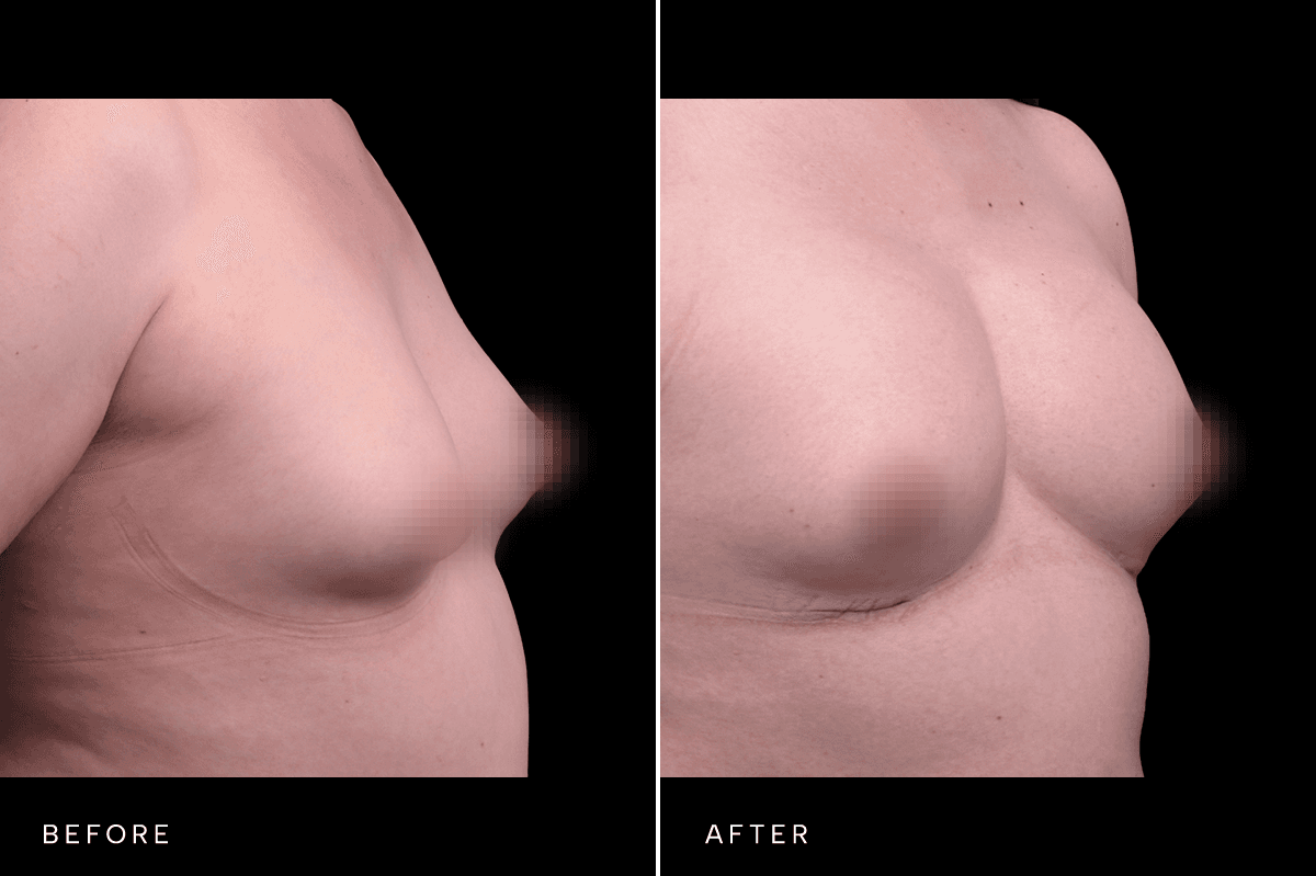 Omni Breast Gallery - BAM GC 6239 - C Angle