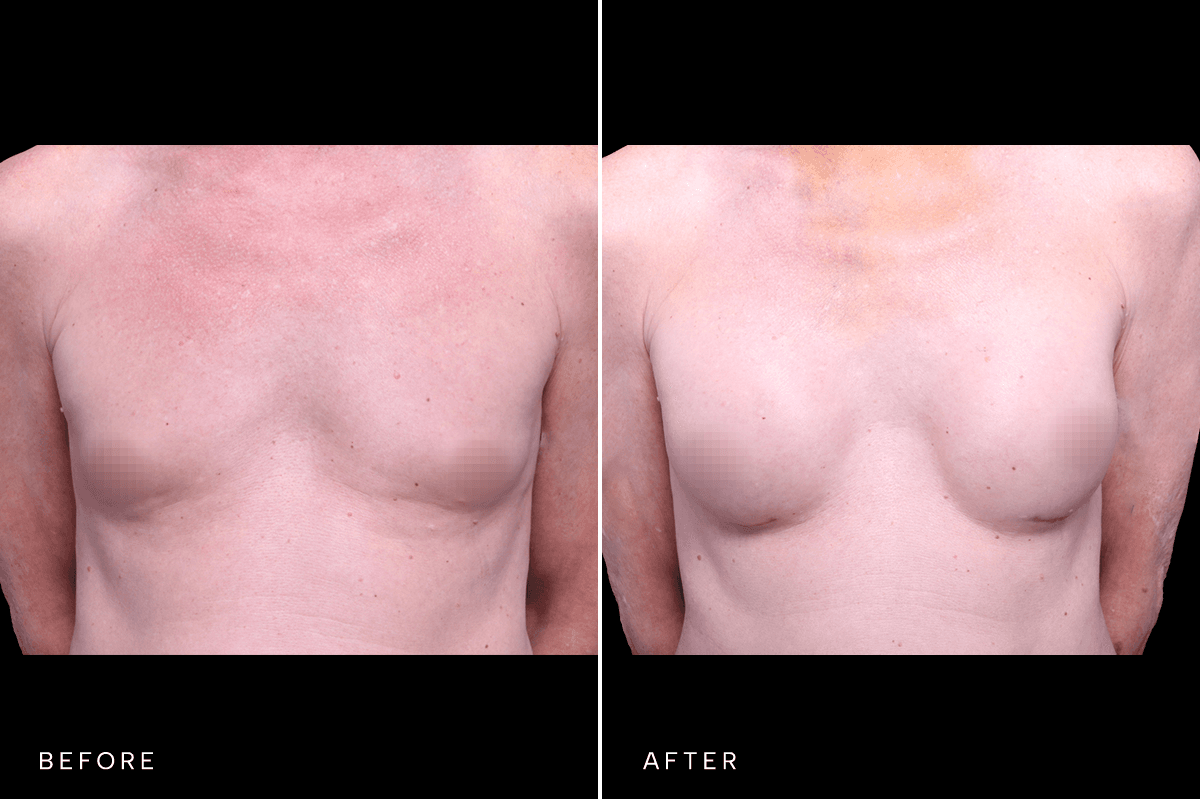 Omni Breast Gallery - BAM GC 5353 - A Front