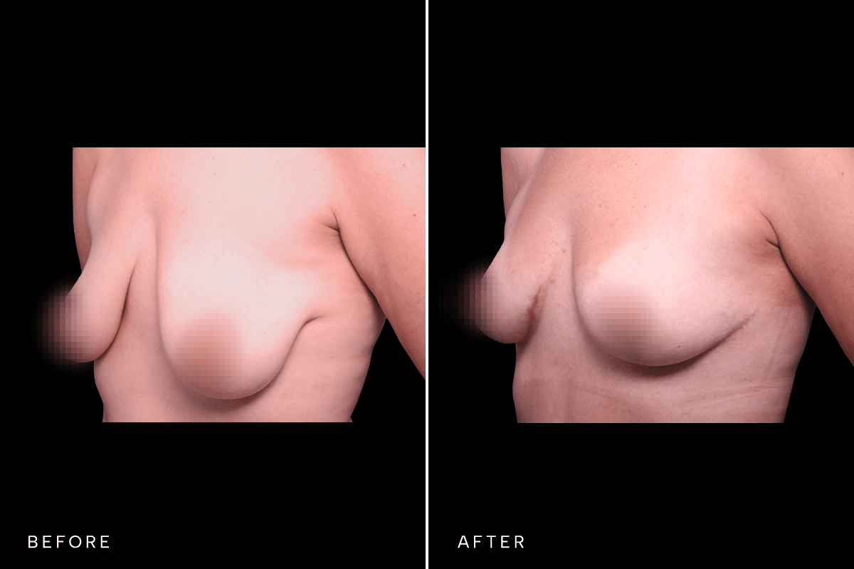 Omni Breast Gallery - Masto 0340 - B Angle