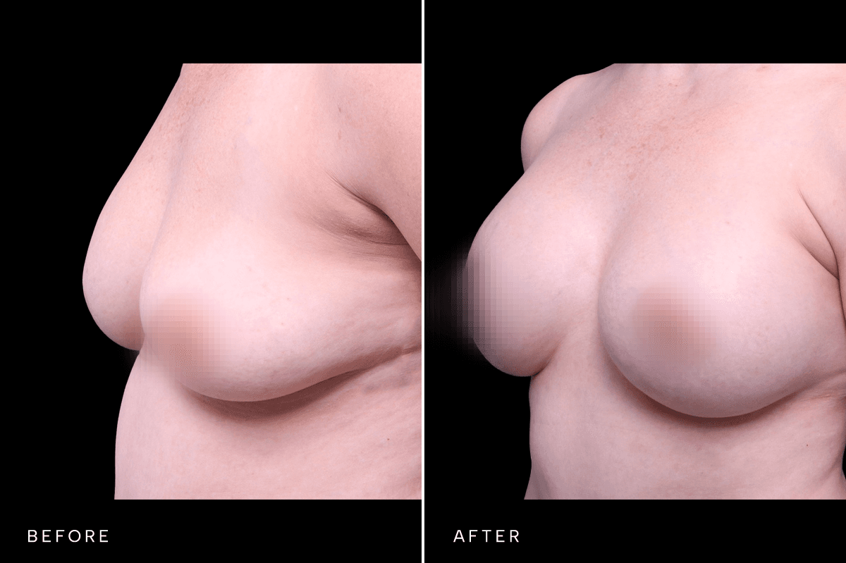 Omni Breast Gallery - BAM 10434 - C Angle