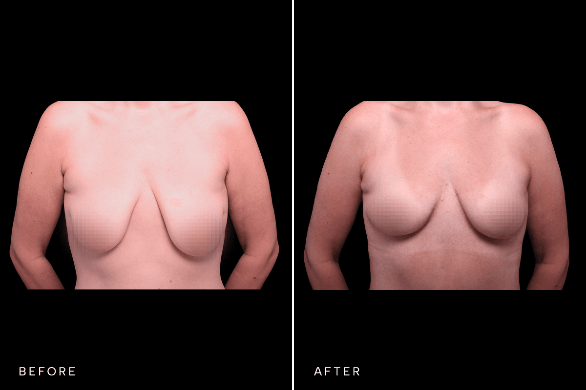 Omni Breast Gallery - Masto 0340 - A Front