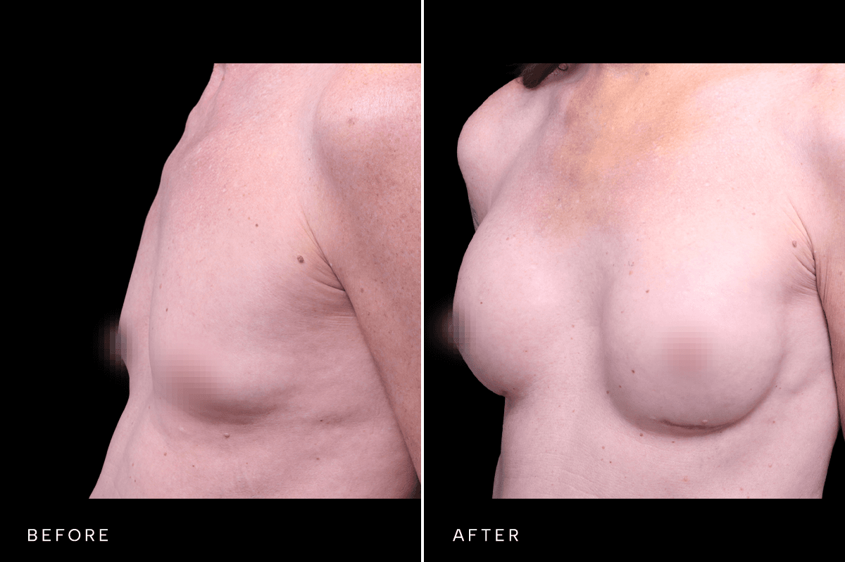 Omni Breast Gallery - BAM GC 5353 - D Angle
