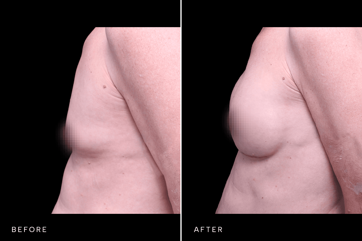 Omni Breast Gallery - BAM GC 5353 - E Side