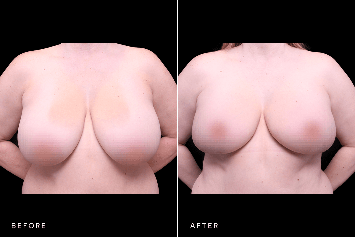 Omni Breast Gallery - MASTO 5567 - A Front