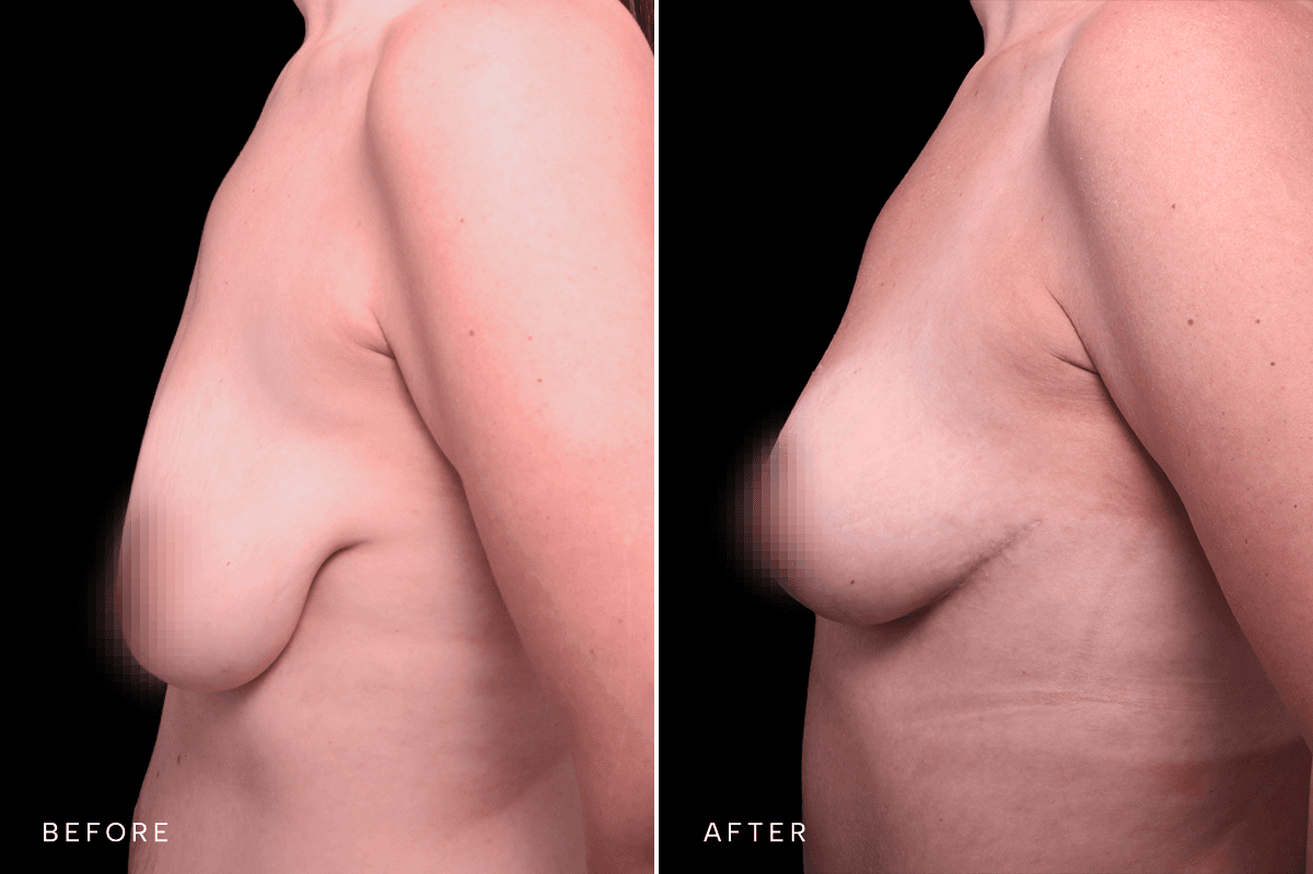 Omni Breast Gallery - Masto 0340 - C Side