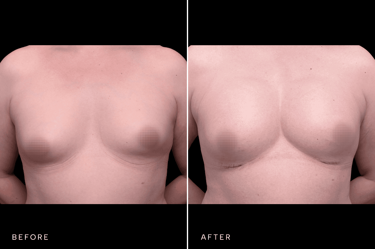 Omni Breast Gallery - BAM GC 6239 - A Front