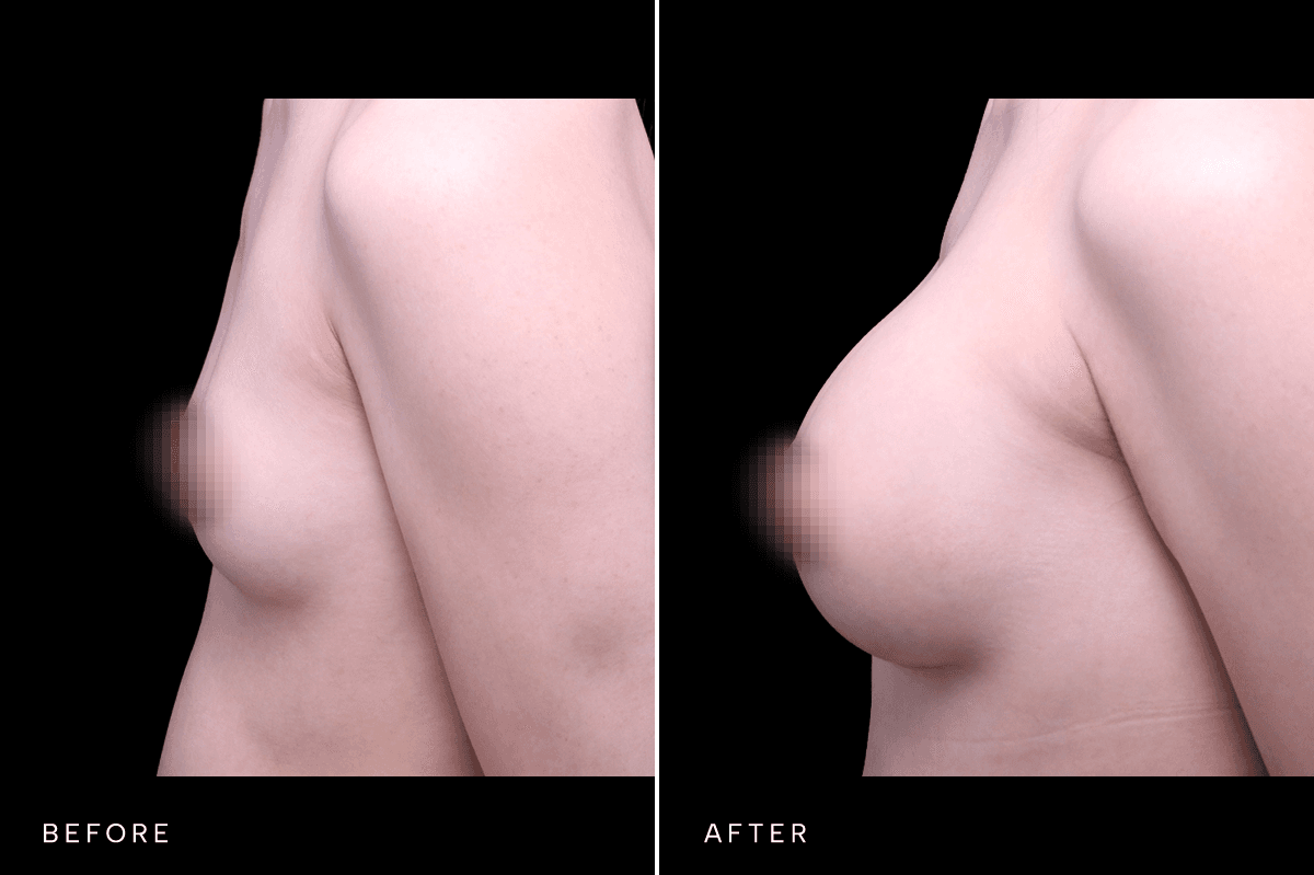Omni Breast Gallery - BAM GC 6505 - B Side