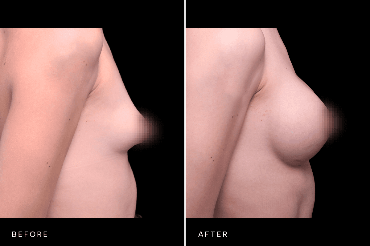 Omni Breast Gallery - BAM GC 5083 - B Side