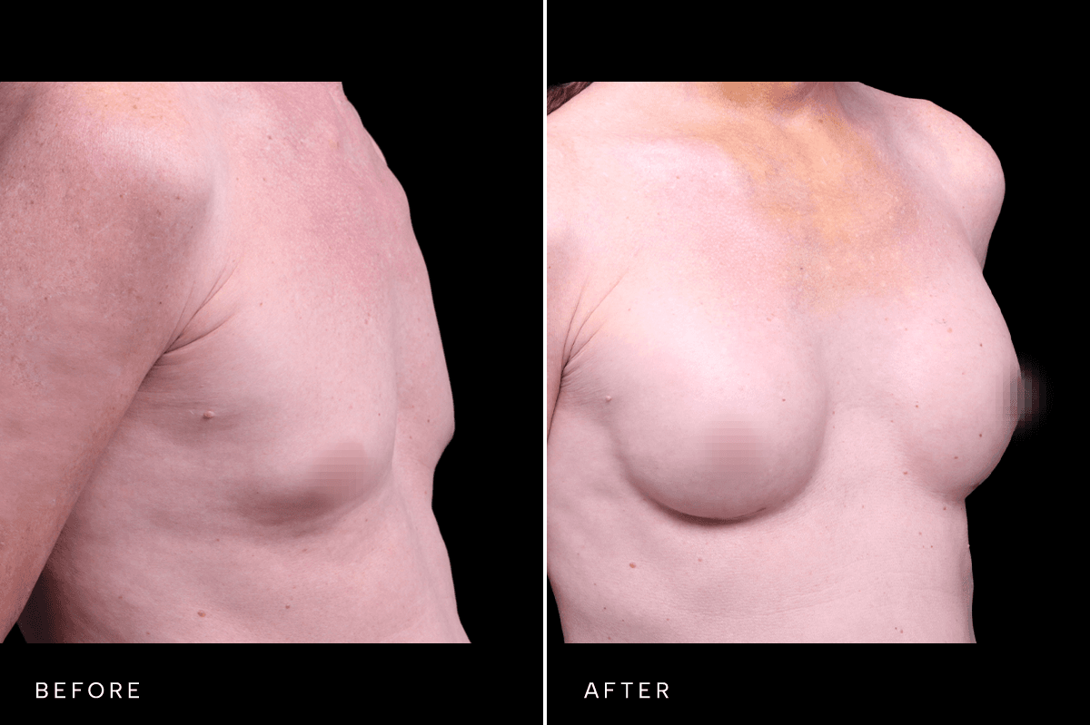 Omni Breast Gallery - BAM GC 5353 - C Angle