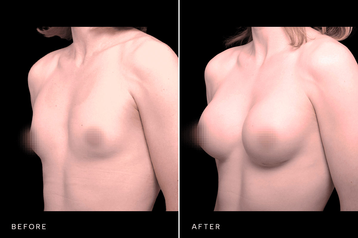 Omni Breast Gallery - BAM GC 4855 - B Angle
