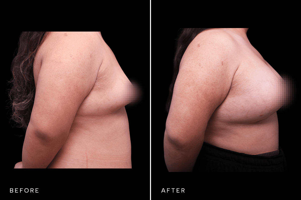 Omni Breast Gallery - BAM 4555 GC - B Side
