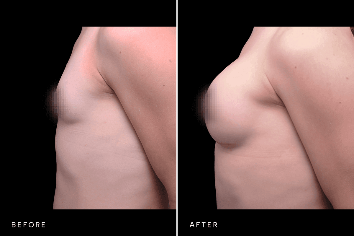 Omni Breast Gallery - BAM GC 4902 - C Side