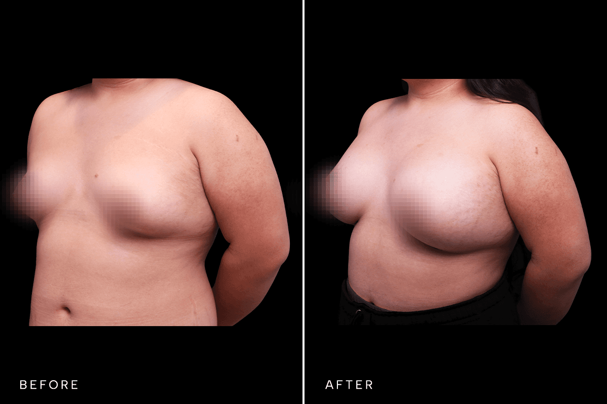 Omni Breast Gallery - BAM 4555 GC - D Angle