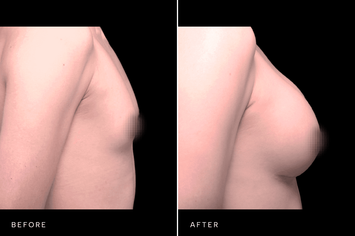 Omni Breast Gallery - BAM GC 4855 - E Side