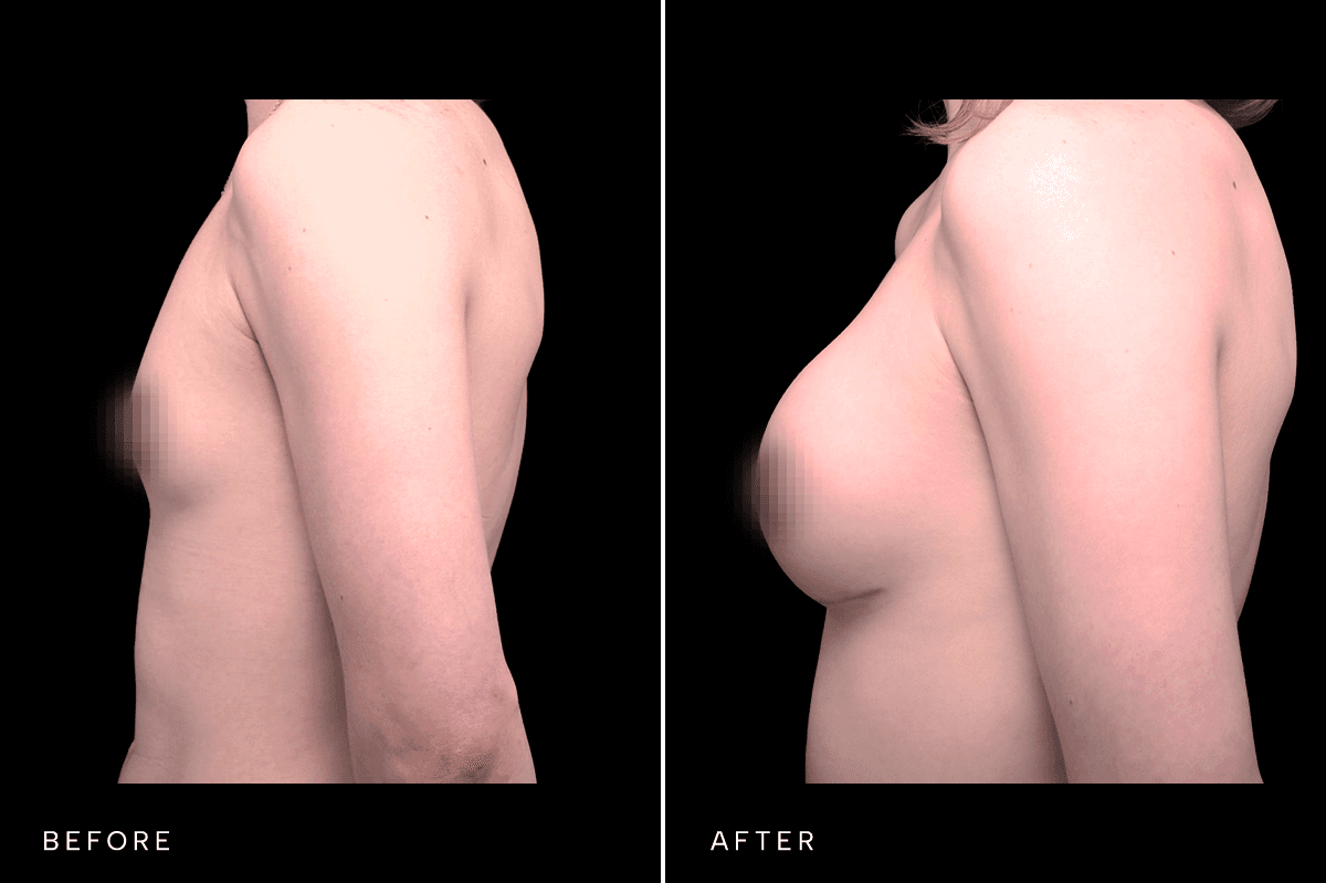 Omni Breast Gallery - BAM GC 4855 - C Side