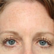 Omni Blog — BOTOX® Cosmetic is #1 Non-Surgical Procedure
