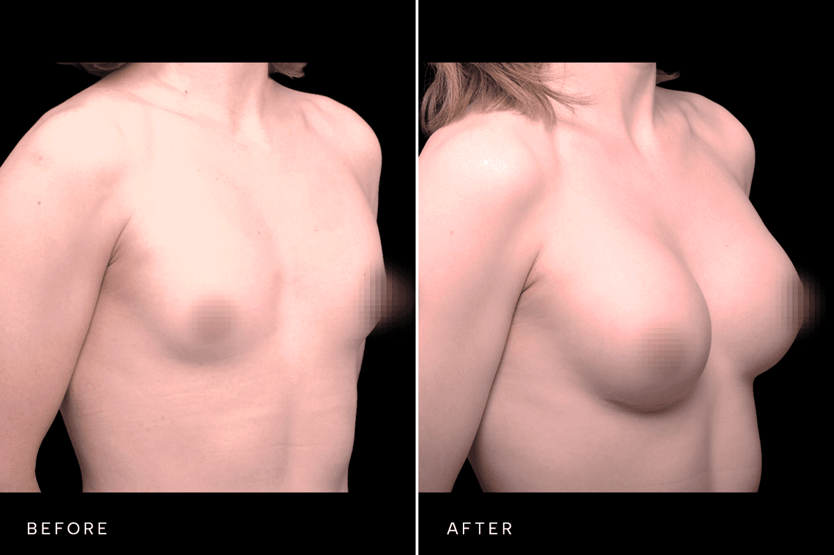 Omni Breast Gallery - BAM GC 4855 - D Angle