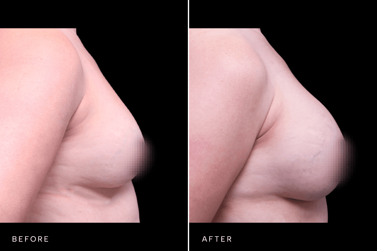 Omni Breast Gallery - BAM 10434 - B Side