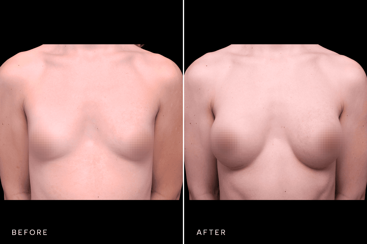 Omni Breast Gallery - BAM GC 5083 - A Front