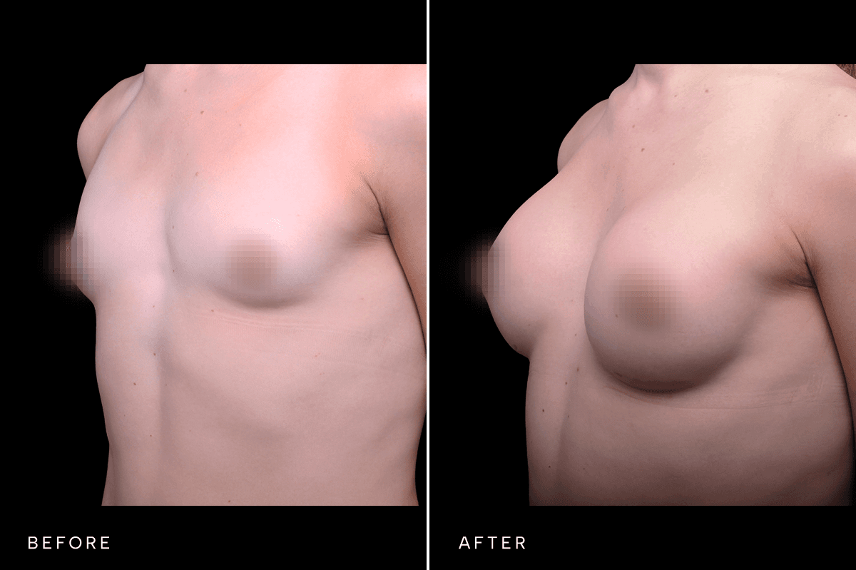 Omni Breast Gallery - BAM GC 4902 - B Angle