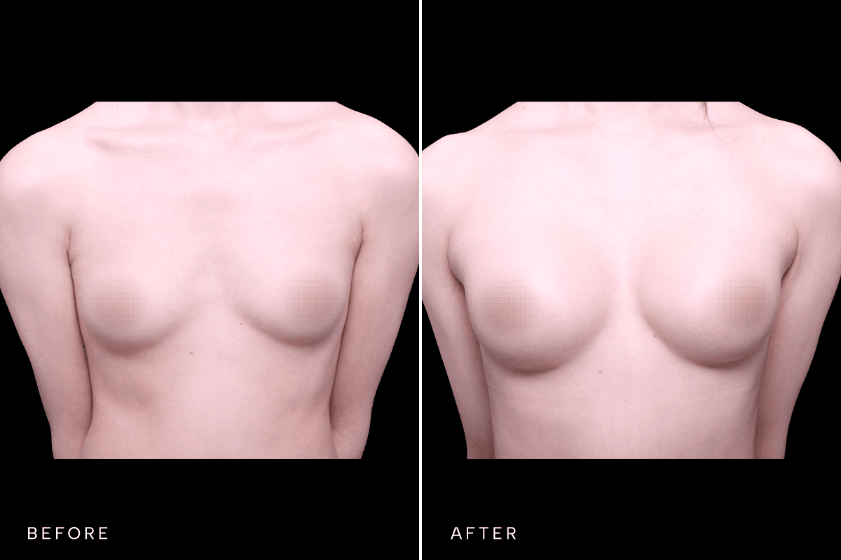 Omni Breast Gallery - BAM GC 6505 - A Front