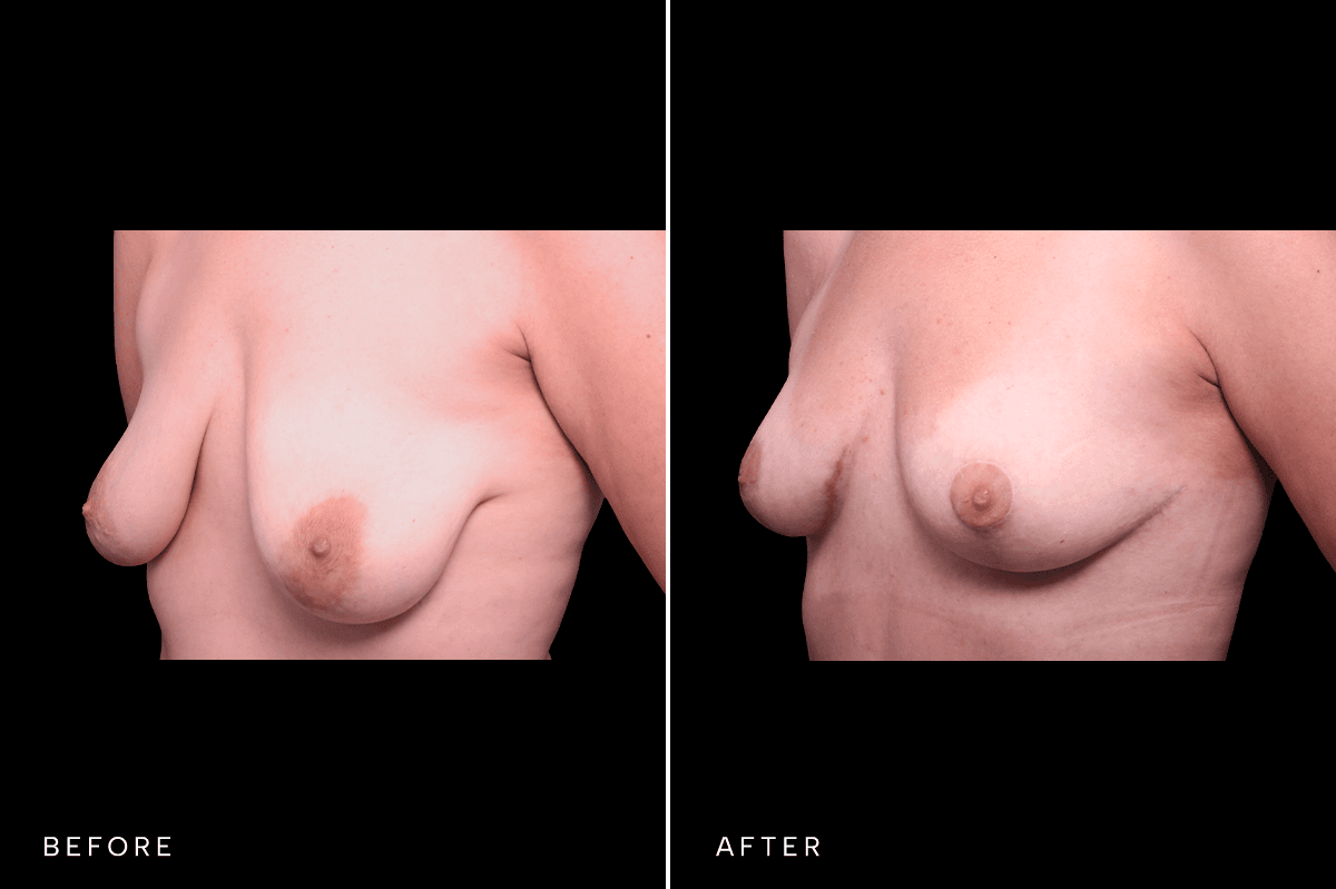 Omni Breast Gallery - Masto 0340 - B Angle