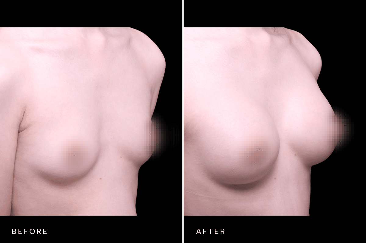 Omni Breast Gallery - BAM GC 6505 - C Angle