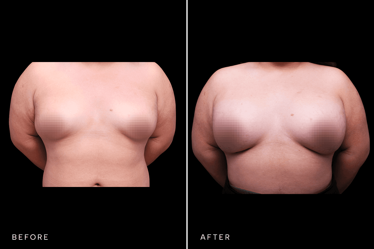 Omni Breast Gallery - BAM 4555 GC - A Front