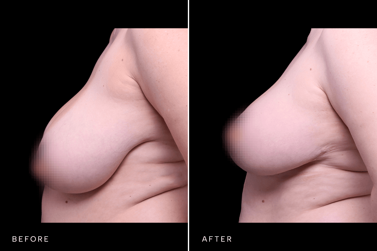 Omni Breast Gallery - MASTO 5567 - D Side