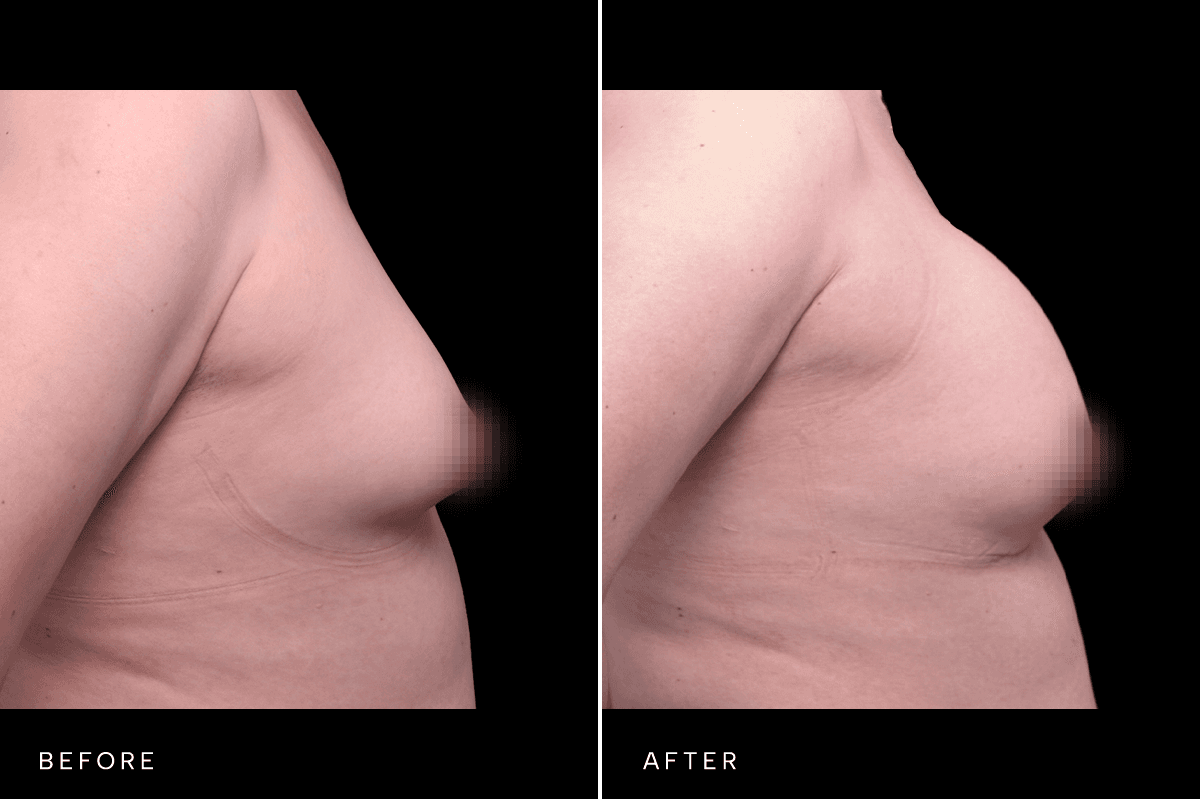 Omni Breast Gallery - BAM GC 6239 - D Side