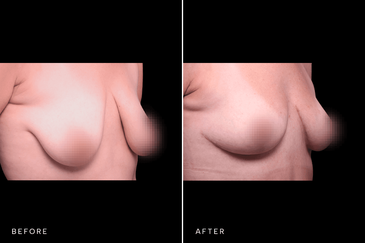 Omni Breast Gallery - Masto 0340 - D Angle