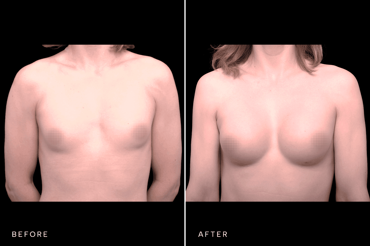 Omni Breast Gallery - BAM GC 4855 - A Front