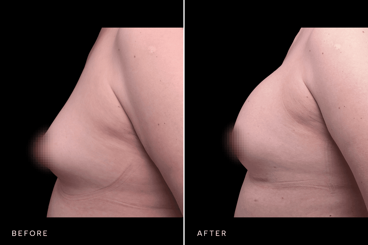 Omni Breast Gallery - BAM GC 6239 - B Side