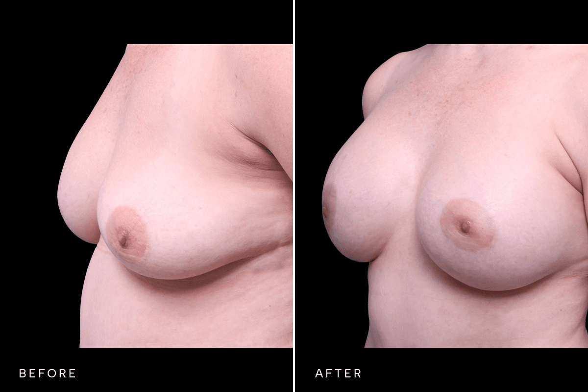 Omni Breast Gallery - BAM 10434 - C Angle