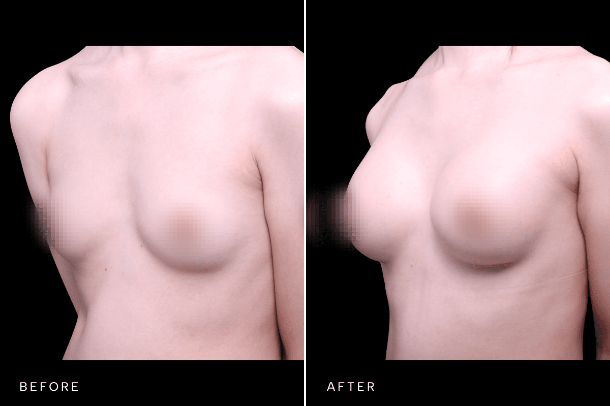 Omni Breast Gallery - BAM GC 6505 - D Angle