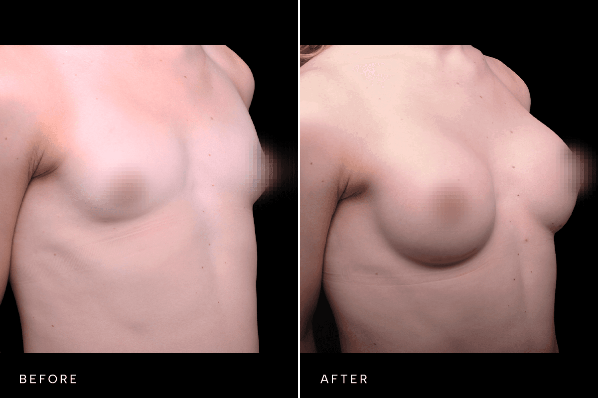 Omni Breast Gallery - BAM GC 4902 - D Angle