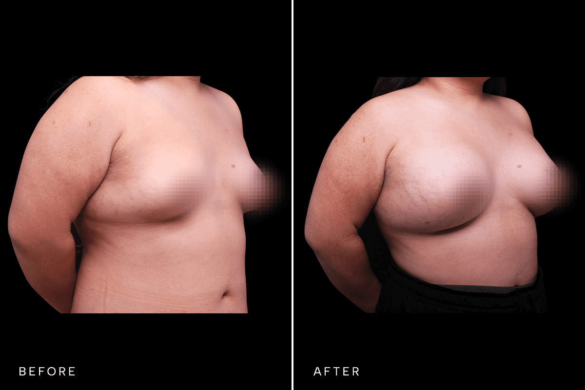 Omni Breast Gallery - BAM 4555 GC - C Angle