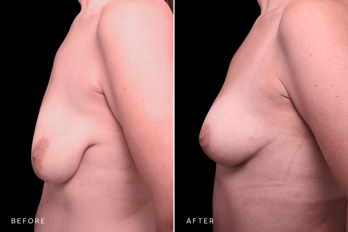 Omni Breast Gallery - Masto 0340 - C Side
