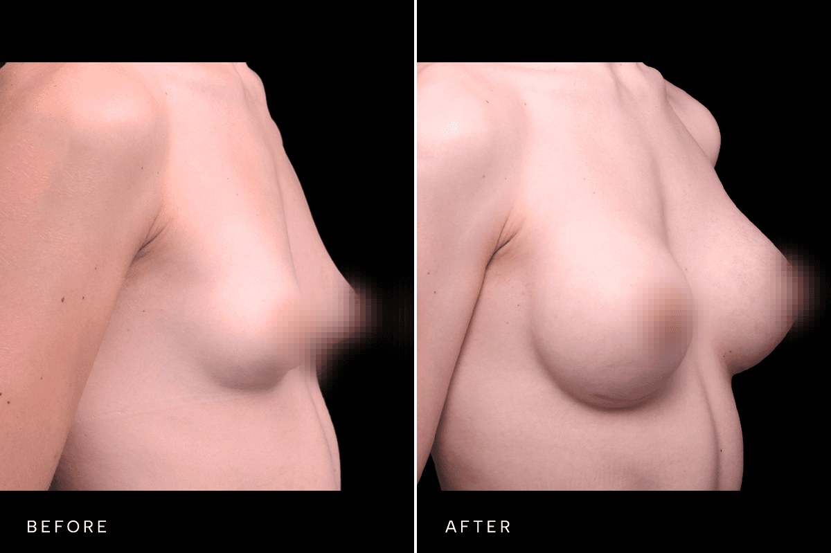 Omni Breast Gallery - BAM GC 5083 - C Angle