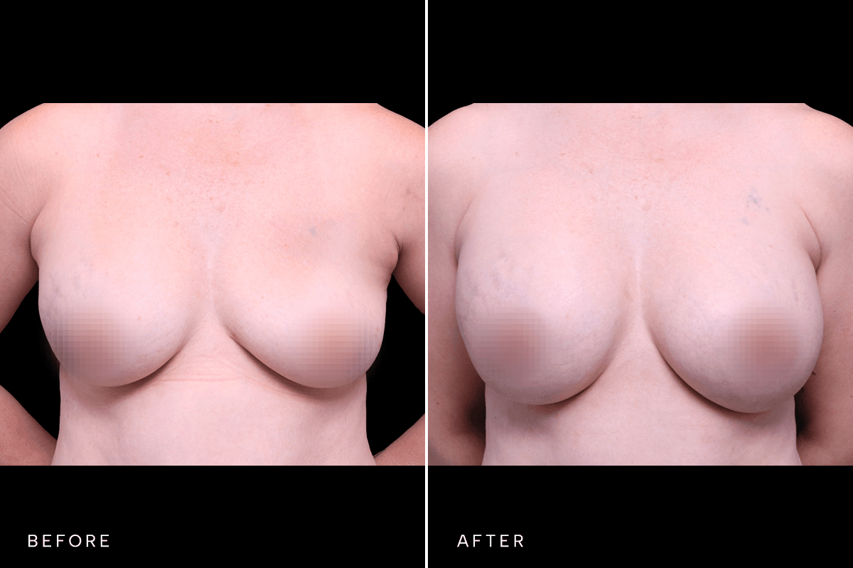 Omni Breast Gallery - BAM 10434 - A Front