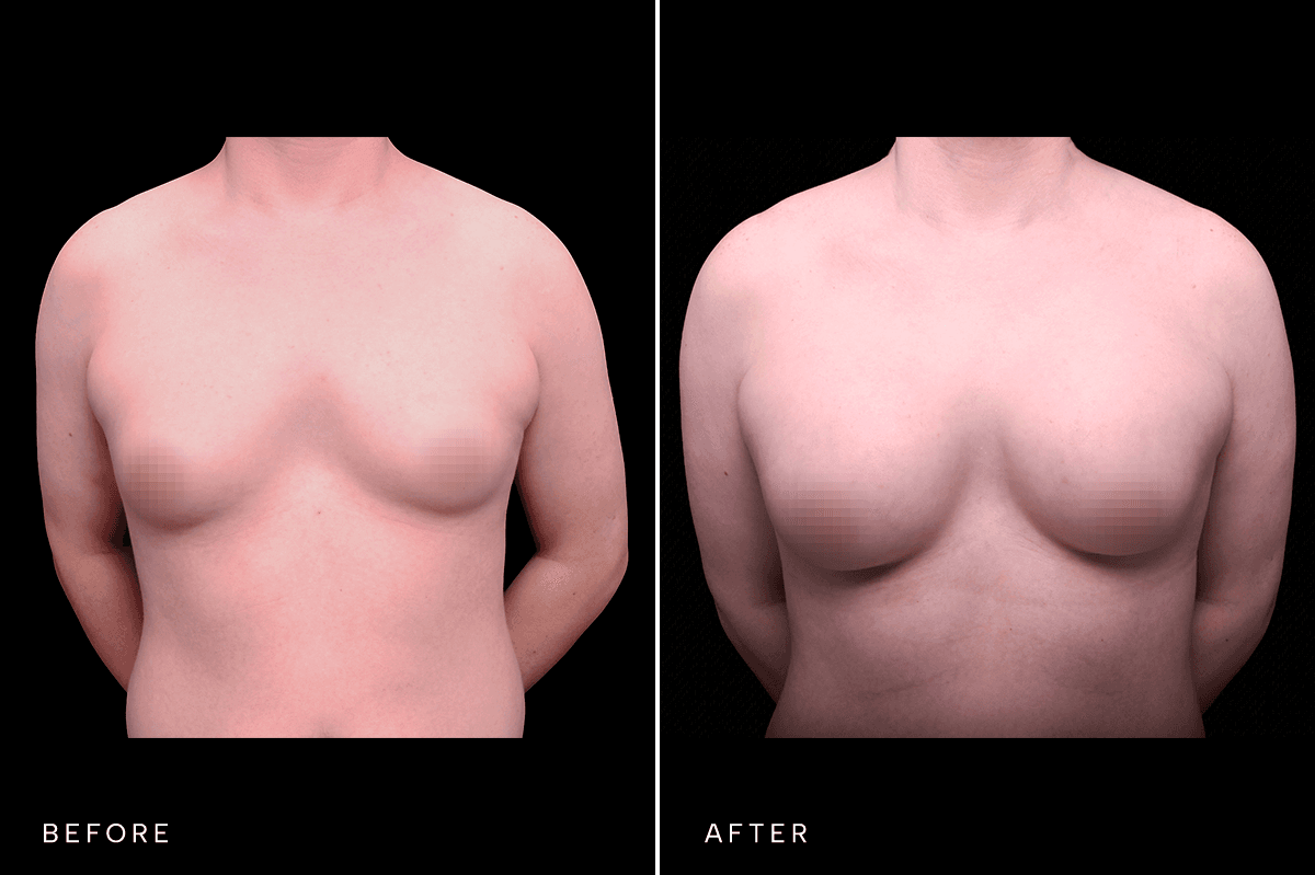 Omni Breast Gallery - BAM 4556 GC - A Front