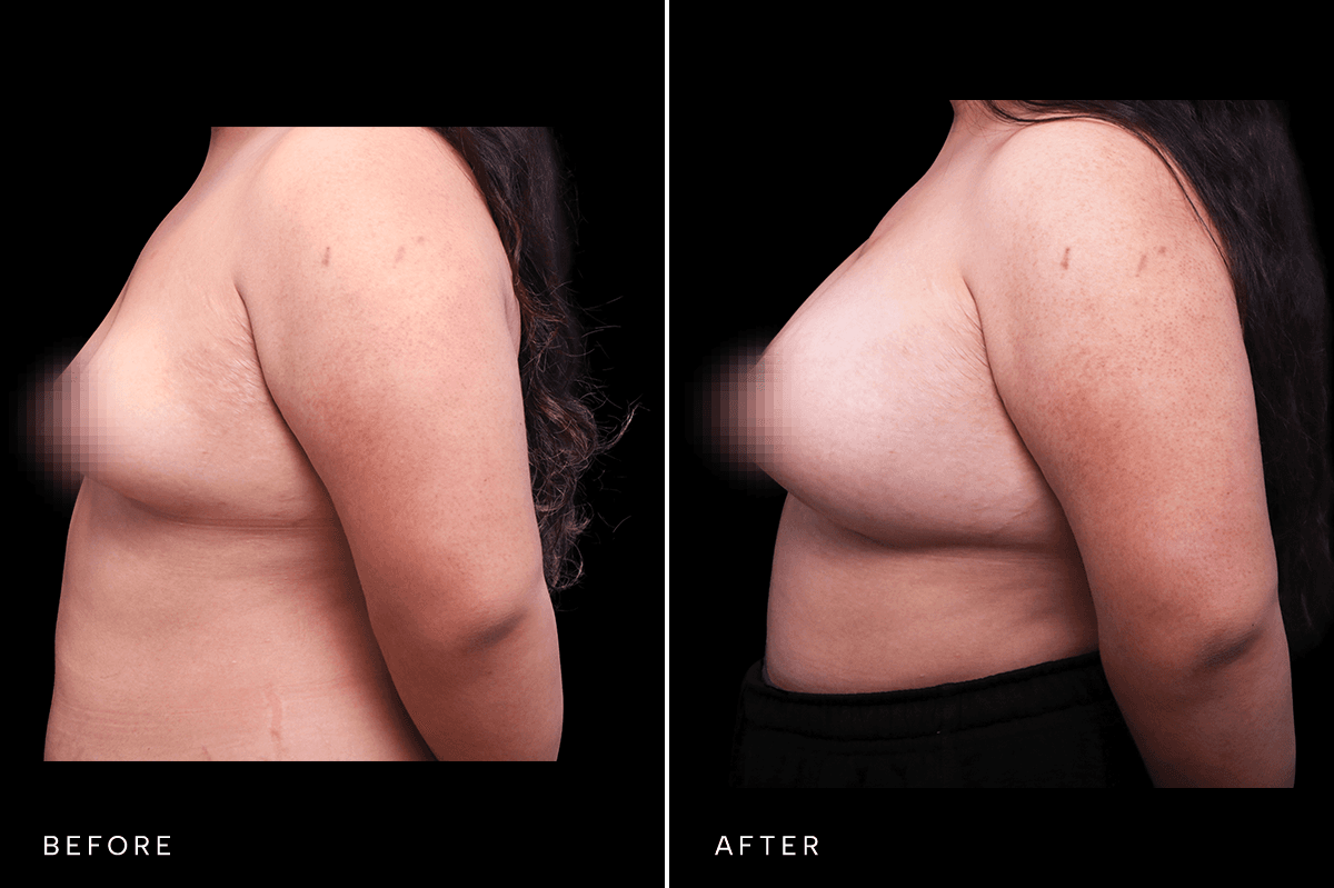 Omni Breast Gallery - BAM 4555 GC - E Side