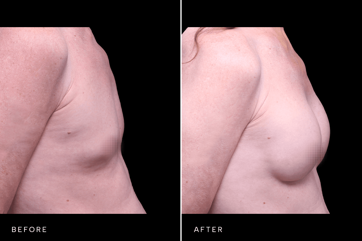 Omni Breast Gallery - BAM GC 5353 - B Side