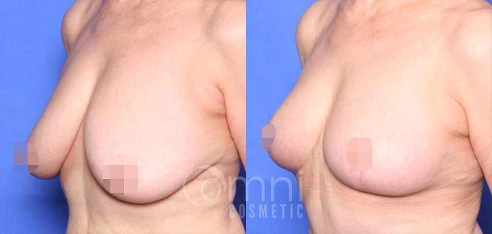 OmniCosmetic_Breast-lift_BA_Patient-1_Oblique_Censored3