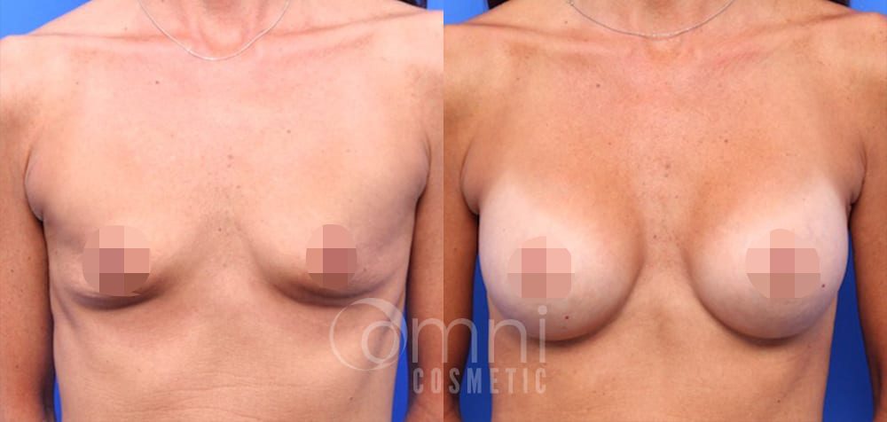OmniCosmetic_BreastAugmentation_BA_34_Patient-22_Front_Censored3