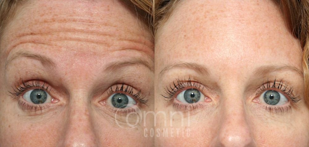 OmniCosmetic_Botox_B&A_Patient 1