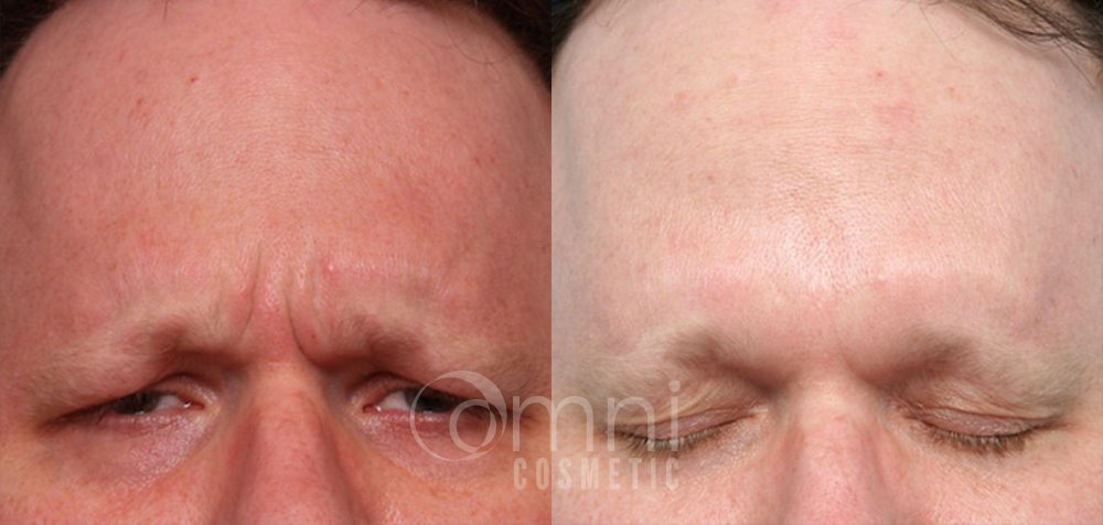 OmniCosmetic_Botox_B&A_Patient 3