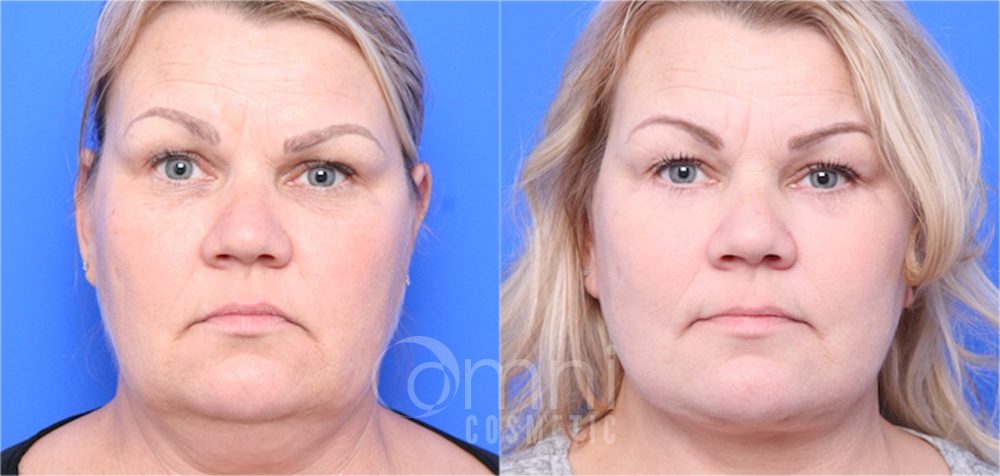 0001_OmniCosmetic_Wayzata_face_facelift_B&A_Patient1_front